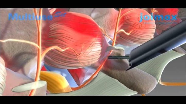 Indications for Endoscopic Rhizotomy
