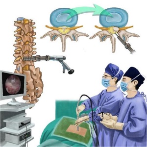 Endoscopic Spine Fusion