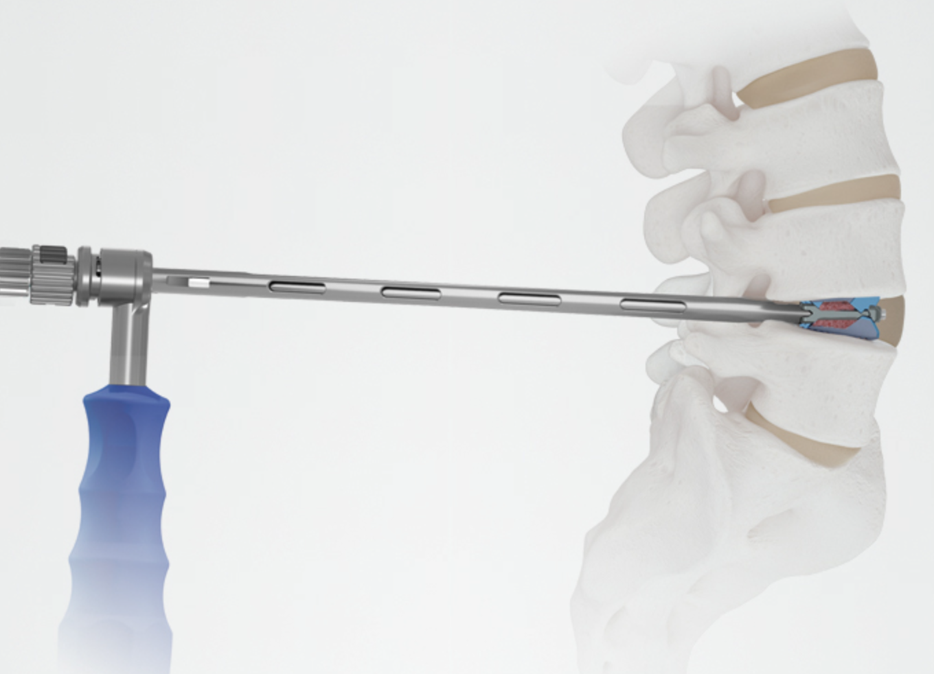 Endoscopic Spine Fusion Procedure