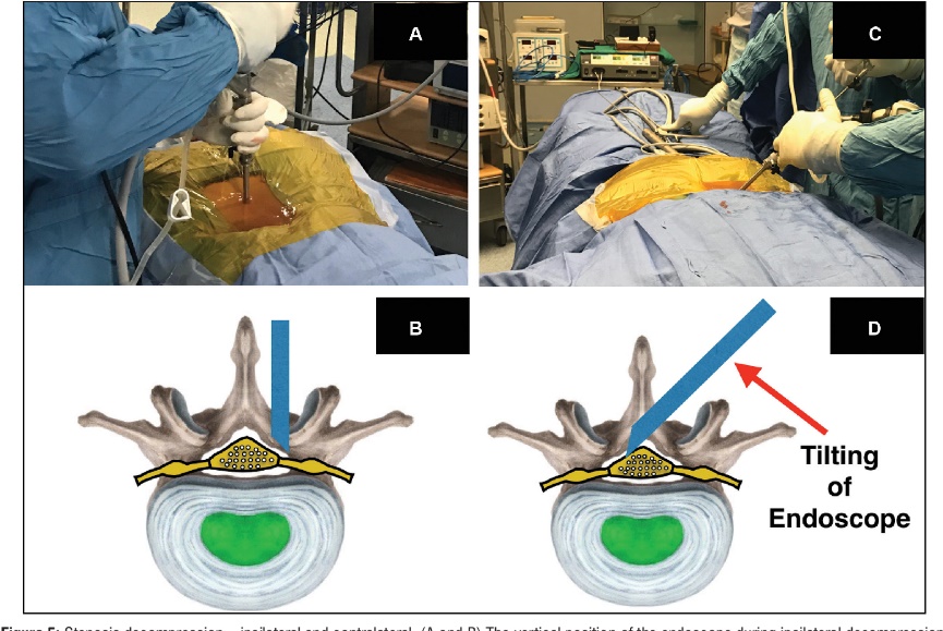Conditions Treated with Interlaminar Surgery