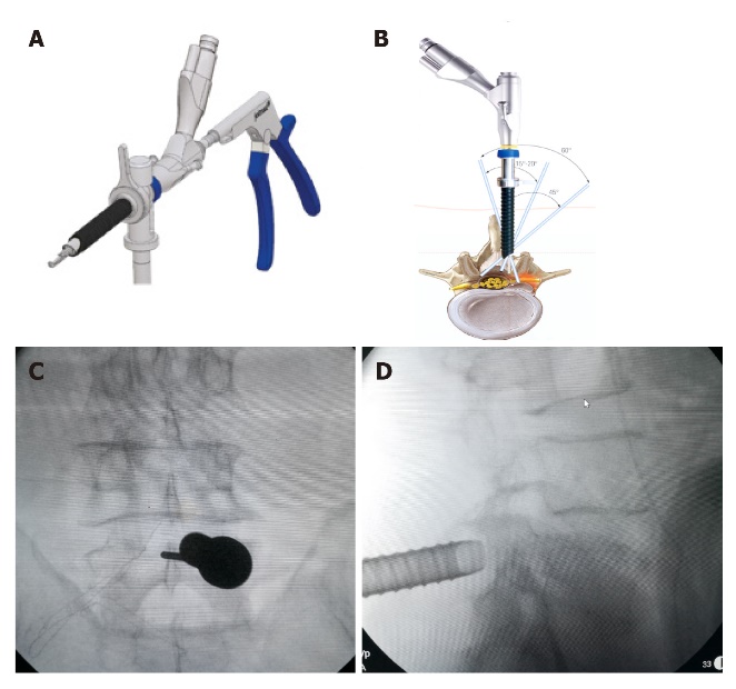Interlaminar Endoscopic Surgery Overview