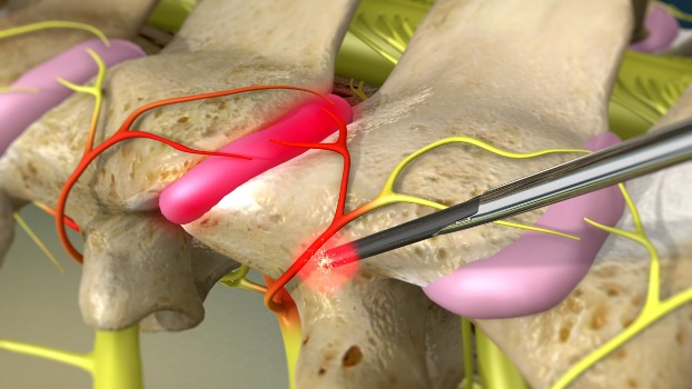 Endoscopic Rhizotomy Procedure